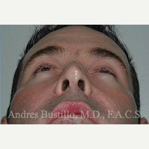 25 year old man treated with Revision Rhinoplasty after 3460638
