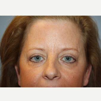 45-54 year old woman treated with Eyelid Surgery after 3708617