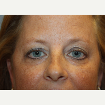 45-54 year old woman treated with Eyelid Surgery before 3708617