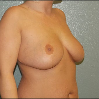 Breast Augmentation, Breast Implants 1527120