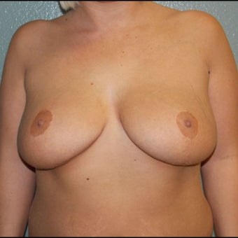 Breast Augmentation, Breast Implants before 1527120