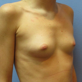 25-34 year old woman treated with Breast Augmentation before 3319931