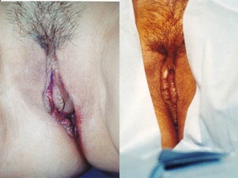 BEFORE AND IMMEDIATELY AFTER LABIAPLASTY before 1231055