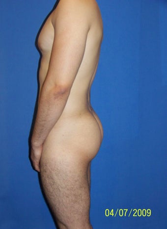 Butt Implants (Gluteal Implants) before 1454361