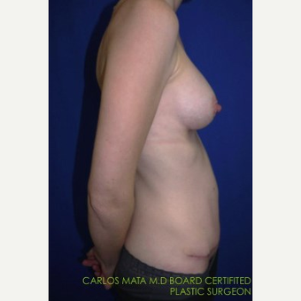 Breast Augmentation after 3744205