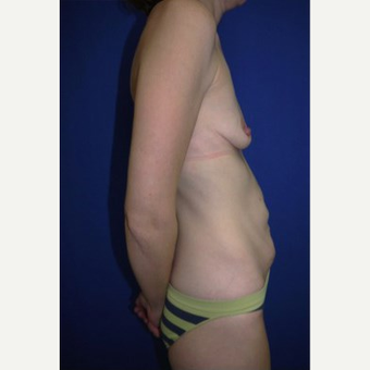 Breast Augmentation before 3744205