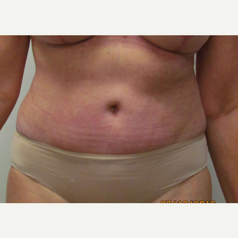 Tummy Tuck for this 55 Year Old Woman after 3791730