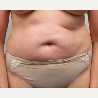 Tummy Tuck for this 55 Year Old Woman before 3791730