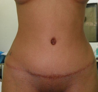 25-34 year old woman treated with Tummy Tuck after 3122914
