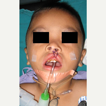 Cleft Lip And Palate Repair before 3711061