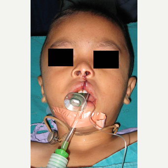 Cleft Lip And Palate Repair after 3711061