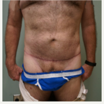 55-64 year old man treated with Male Tummy Tuck after 3454389