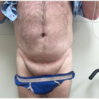 55-64 year old man treated with Male Tummy Tuck before 3454389