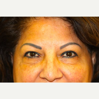55-64 year old woman treated with Eye Bags Treatment before 2751274