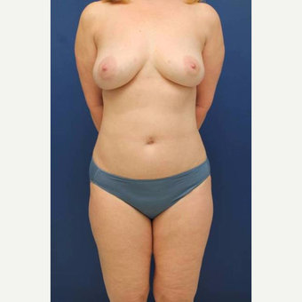 54 year old female who wanted her breast implants removed and fat transferred to her breasts after 2853948