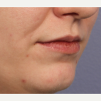 25-34 year old woman treated with Juvederm before 3659995