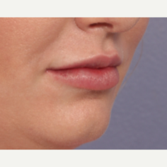25-34 year old woman treated with Juvederm after 3659995