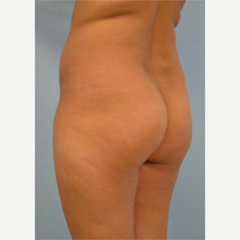 38 year old woman treated with Brazilian Butt Lift before 3432367