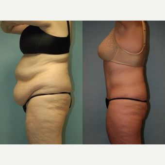 58 year old woman, 5'6", 188 lbs. four months after lipoabdominoplasty before 3771628