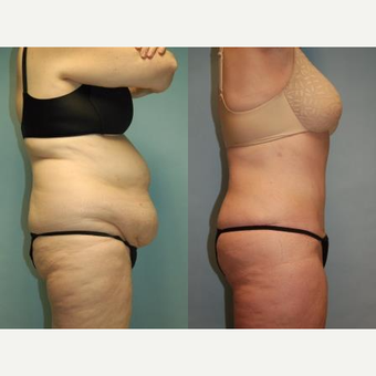 58 year old woman, 5'6", 188 lbs. four months after lipoabdominoplasty after 3771628