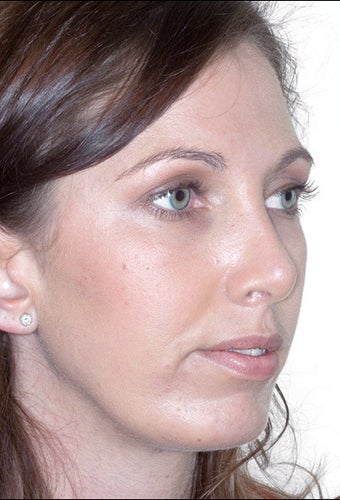 Rhinoplasty and Chin Augmentation after 1023312