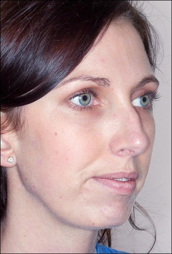 Rhinoplasty and Chin Augmentation before 1023312