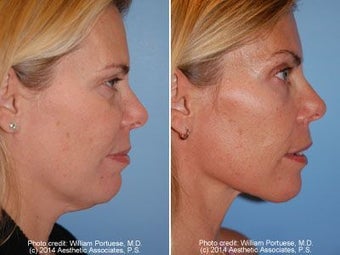 Neck Liposuction before 212280
