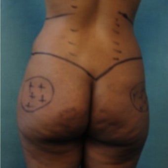 33 year old woman treated with Fat Transfer to Buttock and Hips, Liposuction to Abs, Flank, Back 1811389