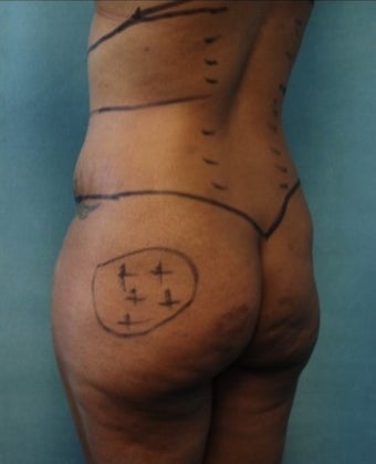33 year old woman treated with Fat Transfer to Buttock and Hips, Liposuction to Abs, Flank, Back before 1811389
