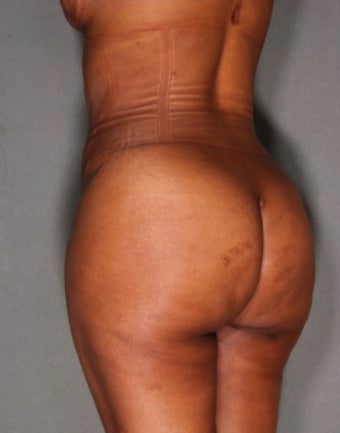 33 year old woman treated with Fat Transfer to Buttock and Hips, Liposuction to Abs, Flank, Back after 1811389