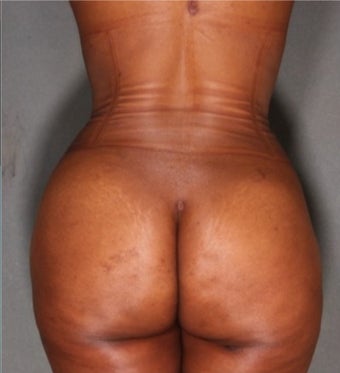 33 year old woman treated with Fat Transfer to Buttock and Hips, Liposuction to Abs, Flank, Back 1811389