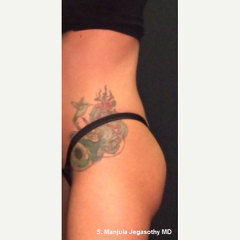 Mild Gluteal Lift with 1 Ultherapy Treatment before 3849012