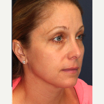 35-44 year old woman treated with IPL after 3137038