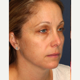 35-44 year old woman treated with IPL before 3137038
