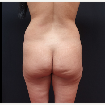25-34 year old woman treated with Tumescent Liposuction before 3280016