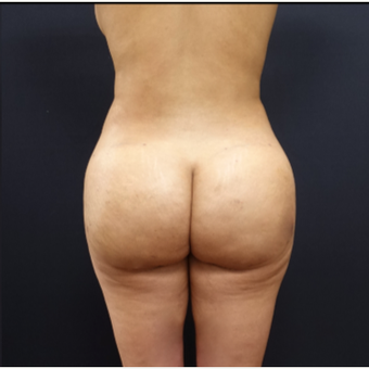 25-34 year old woman treated with Tumescent Liposuction after 3280016