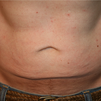 35-44 year old man treated with Fractora RF before 3185504