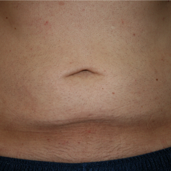 35-44 year old man treated with Fractora RF after 3185504
