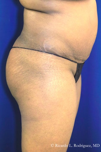 Brazilian Butt Lift before 3305202