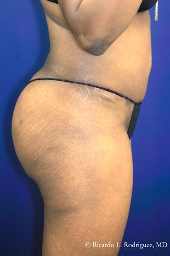 Brazilian Butt Lift after 3305202