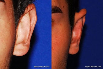 Ear Surgery before 1445763