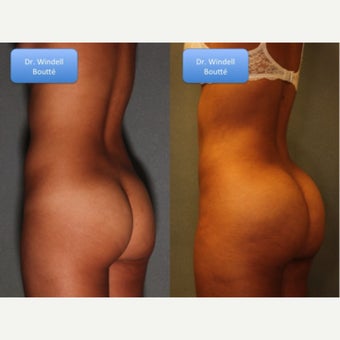 18-24 year old woman treated with Fat Transfer to Buttocks, and Liposuction to Waistline before 1651752
