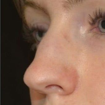 25-34 year old woman treated with Non Surgical Nose Job 1653590
