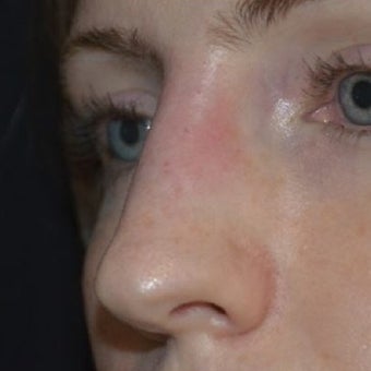 25-34 year old woman treated with Non Surgical Nose Job 1653590