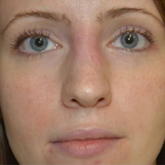 25-34 year old woman treated with Non Surgical Nose Job after 1653590