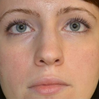 25-34 year old woman treated with Non Surgical Nose Job before 1653590