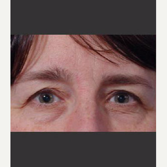 45-54 year old woman treated with Eyelid Surgery before 3711022