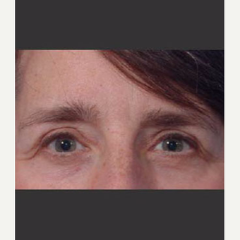 45-54 year old woman treated with Eyelid Surgery after 3711022