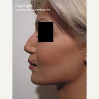 Non Surgical Nose Job to Fix Bump before 2975856