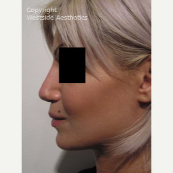 Non Surgical Nose Job to Fix Bump after 2975856